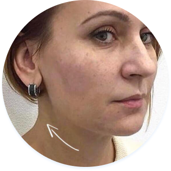 Жінка з підтяжкою